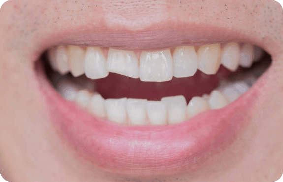 Broken and Chipped tooth at Aardent Dental Centre