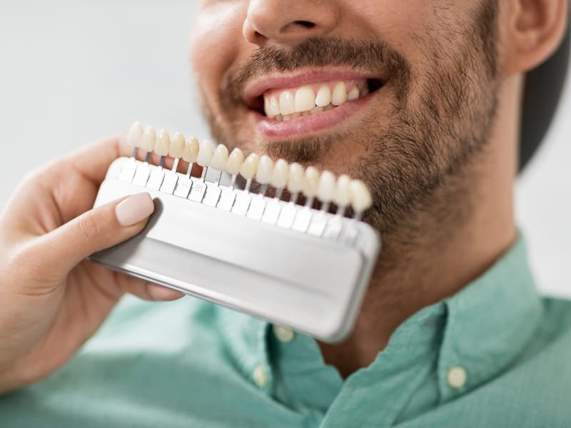 Dental Veneer Care Guide: How to Maintain Veneers