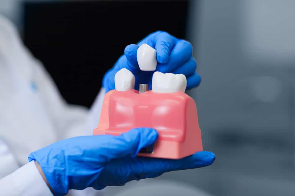 Dental Crowns and Dental Bridges: What are They and How do They Compare?