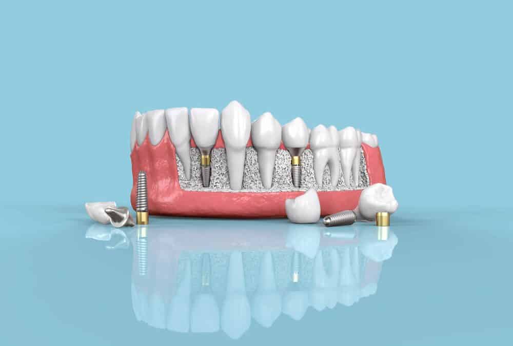 Dental Implants 101: Everything You Need to Know