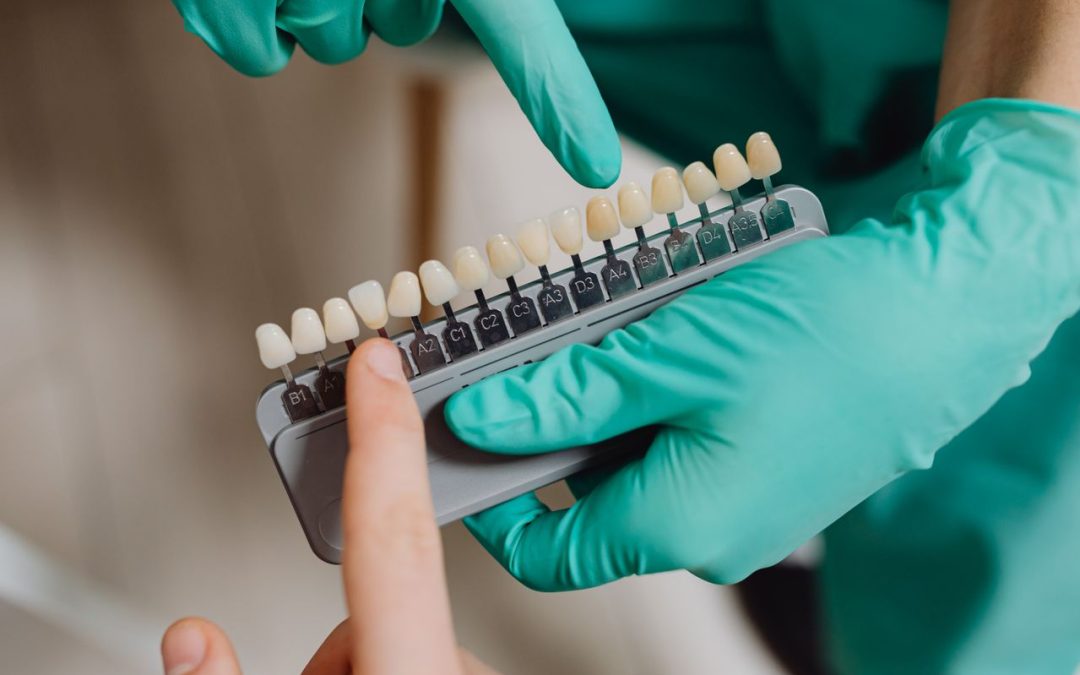 Understanding Dental Veneers
